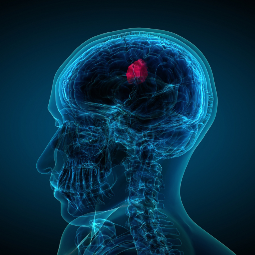 Kenali Tumor Otak Sejak Dini: Penyebab, Tanda, dan Kapan Harus Waspada