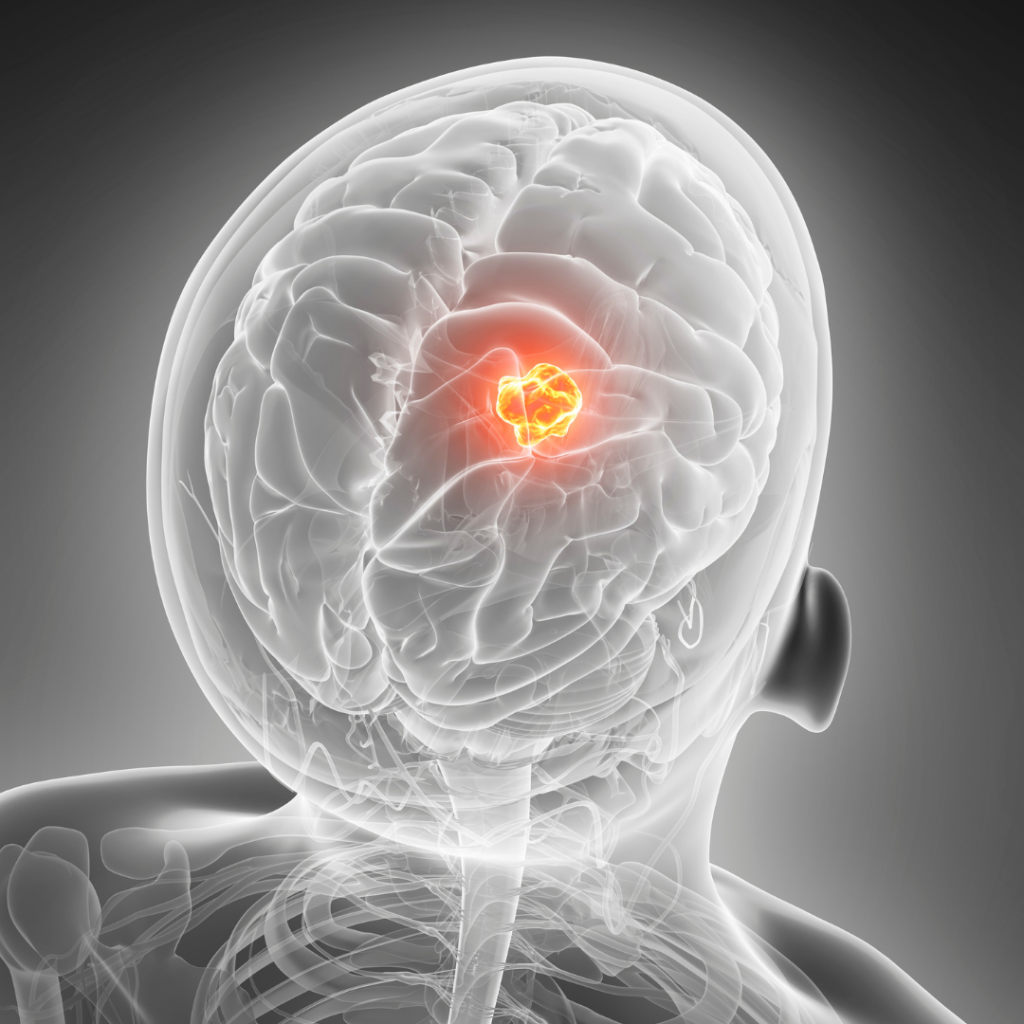 Tumor Otak Bisa Diobati! Kenali Pilihan Penanganannya
