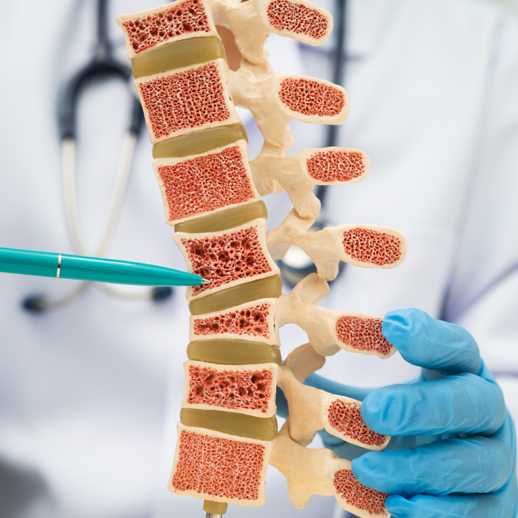 Usia Bertambah, Tulang Makin Rapuh? Waspadai Osteoporosis!